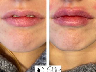 Filler labbra prima e dopo - 877817
