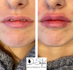 Dr.ssa Rossella Stefini Filler Labbra