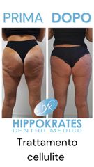 Cellulite - Hippokrates Centro Medico Estetico