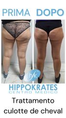 Radiofrequenza - Hippokrates Centro Medico Estetico