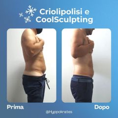 Criolipolisi - Hippokrates Centro Medico Estetico