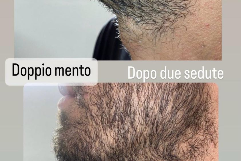 Mesoterapia prima e dopo - 870606