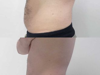 Mesoterapia prima e dopo - 870610