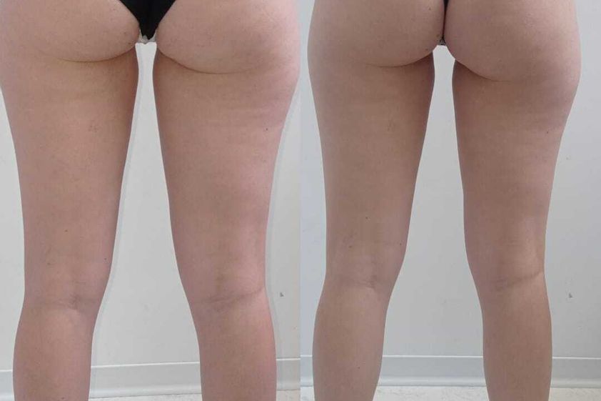 EMSculpt® prima e dopo - 870611