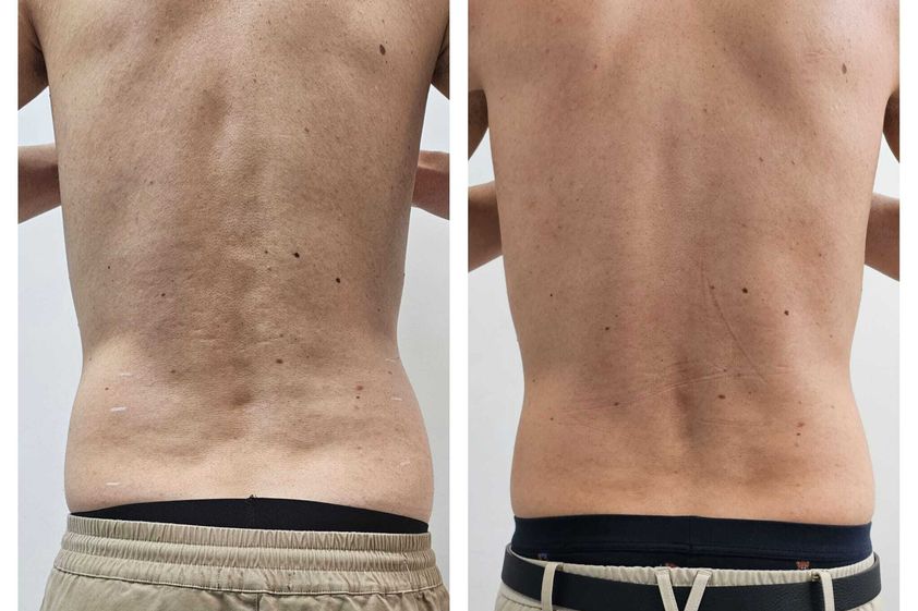 Criolipolisi prima e dopo - 870613