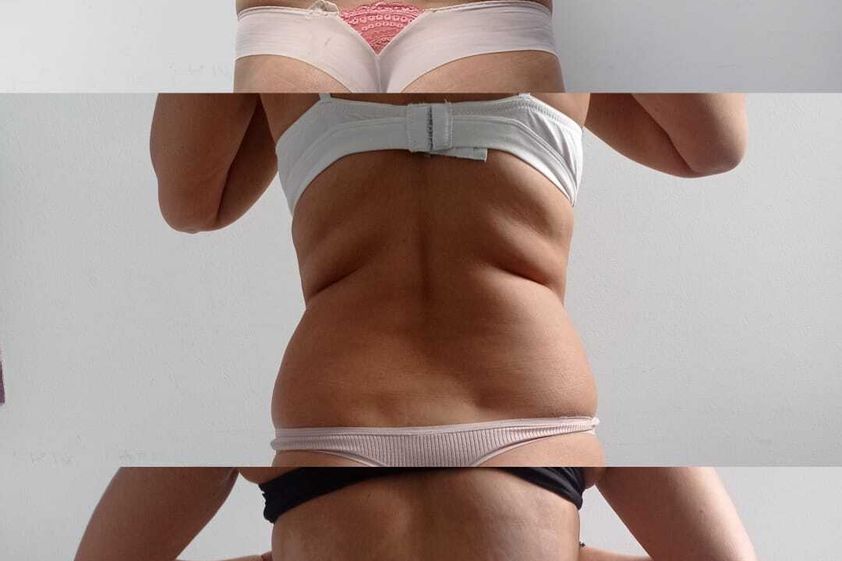 Intralipoterapia prima e dopo - 870615