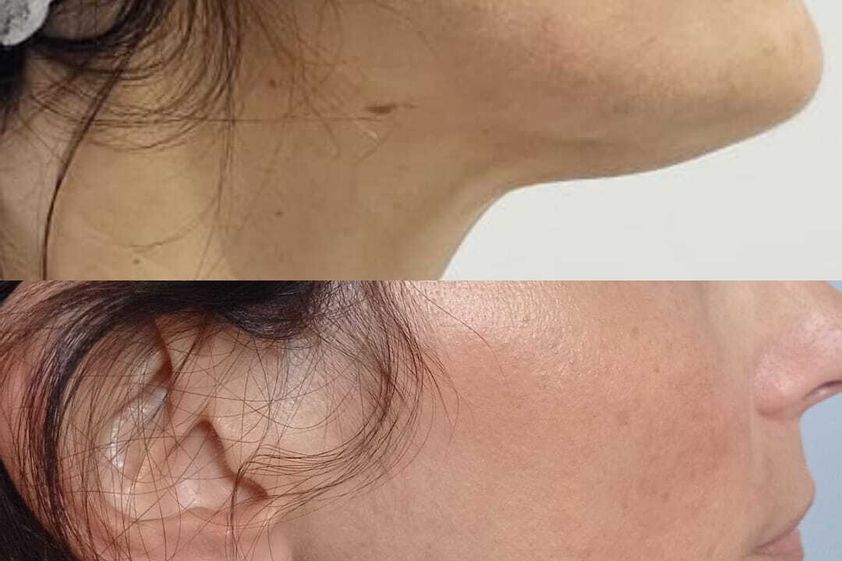 Intralipoterapia prima e dopo - 870616