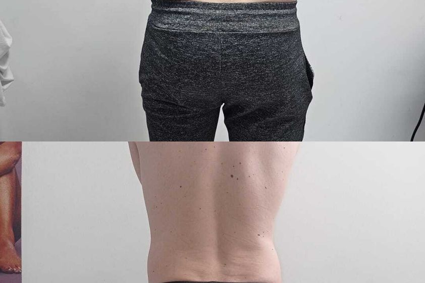 Criolipolisi prima e dopo - 870617