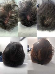 Alopecia - Hippokrates Centro Medico Estetico