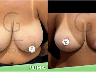 Mastoplastica riduttiva prima e dopo - 854837