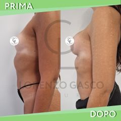 Mastoplastica additiva - Dott. Lorenzo Gasco