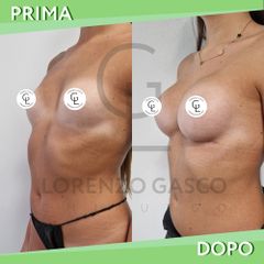 Mastoplastica additiva - Dott. Lorenzo Gasco