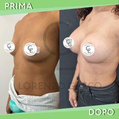 Mastoplastica additiva con simmetrizzazione - Dott. Lorenzo Gasco