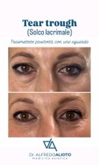 Dr. Alfredo Alioto Solco lacrimale