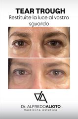 Dr. Alfredo Alioto_Solco lacrimale