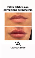 Dr. Alfredo Alioto_fillerlabbra