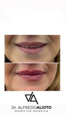 Dr. Alfredo Alioto_fillerlabbra