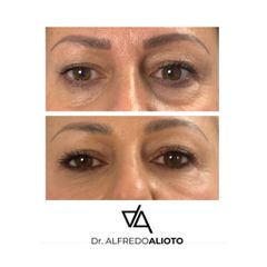 Dr. Alfredo Alioto_Solco lacrimale