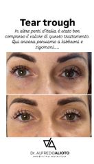 Dr. Alfredo Alioto Solco lacrimale