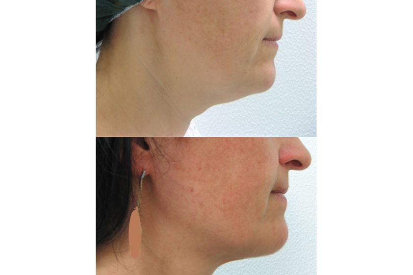 Mentoplastica prima e dopo - 771409