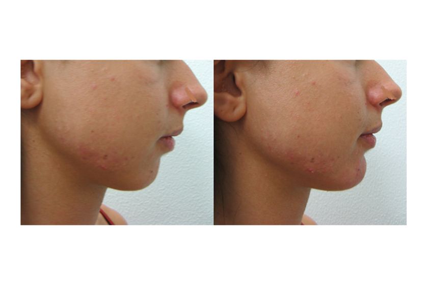 Mentoplastica prima e dopo - 771419
