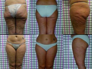 Cellulite prima e dopo