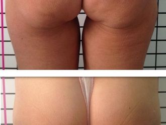 Cellulite prima e dopo - 870774