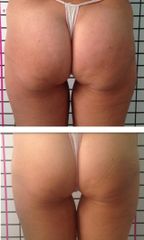 Cellulite - Dott. Giovanni Benfenati