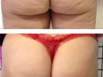 Cellulite prima e dopo - 870775