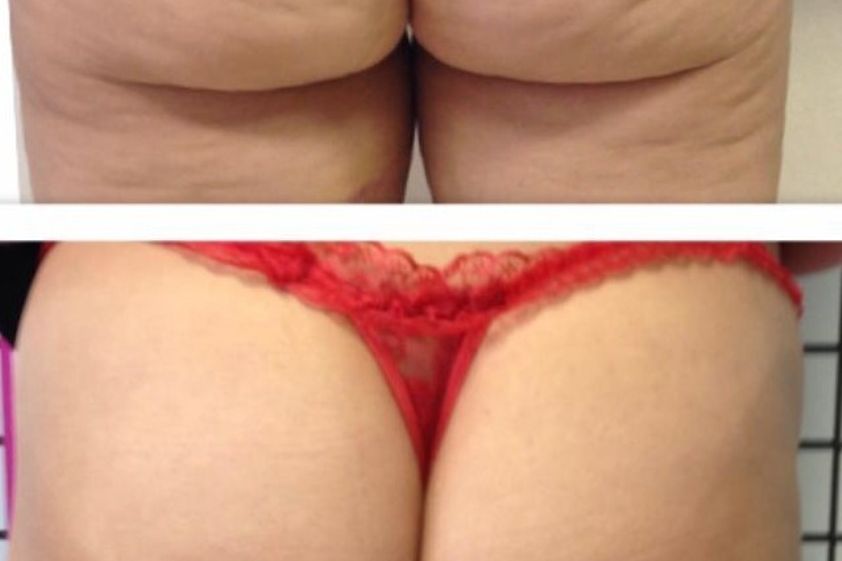 Cellulite prima e dopo - 870775