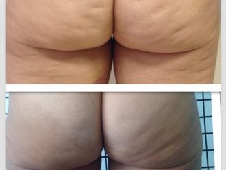 Cellulite prima e dopo - 870776