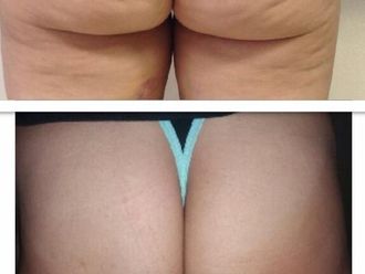 Cellulite prima e dopo - 870777