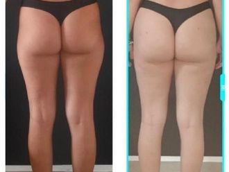 Cellulite prima e dopo - 870783