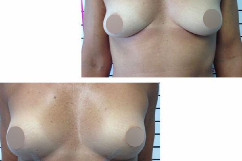 Lipofilling prima e dopo - 870812