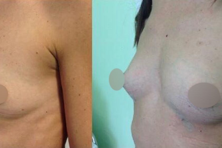 Lipofilling prima e dopo - 870814