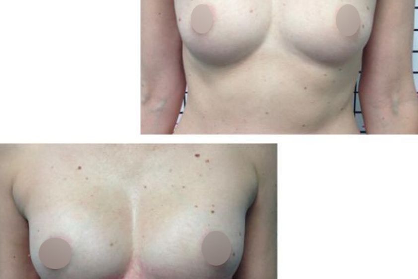 Lipofilling prima e dopo - 870815