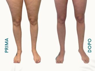 Cellulite prima e dopo - 877740