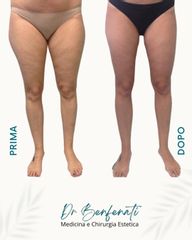 Dott. Giovanni Benfenati Trattamento Integrato Cellulite