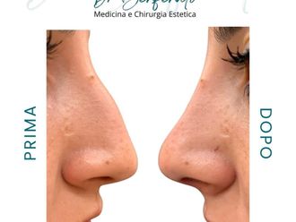 Rinofiller prima e dopo - 877741