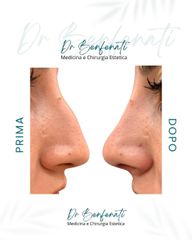 Dott. Giovanni Benfenati Rinofiller con acido ialuronico per armonizzare il profilo nasale