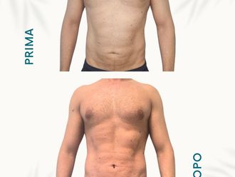 Liposcultura prima e dopo - 877742