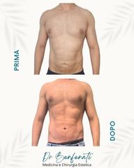 Dott. Giovanni Benfenati Prima e dopo liposcultura ad alta definizione