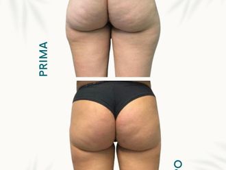 Liposcultura prima e dopo - 877748