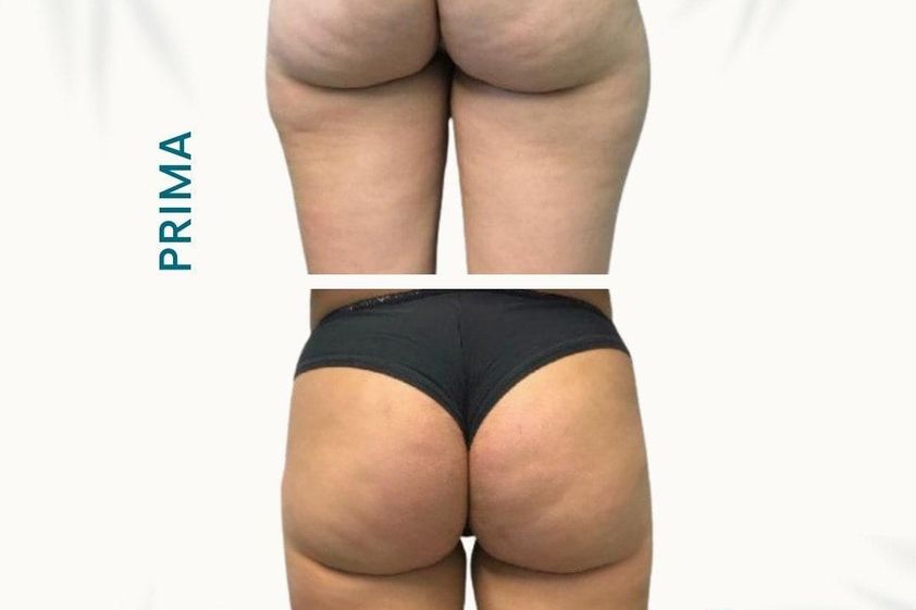 Liposcultura prima e dopo - 877748