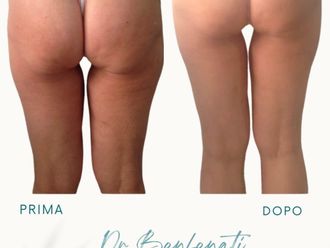 Liposcultura prima e dopo - 877749