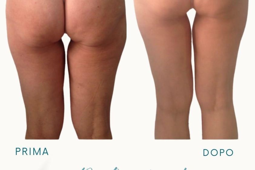 Liposcultura prima e dopo - 877749