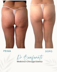 Dott. Giovanni Benfenati Rimodellamento dei fianchi con liposcultura mirata prima e dopo il trattame