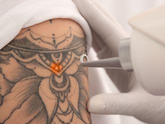 Rimozione tatuaggi prima e dopo - 877750