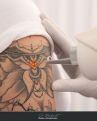 Dott. Giovanni Benfenati Laser Q-Switched per macchie cutanee e rimozione dei tatuaggi