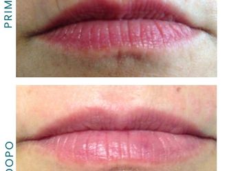 Rughe prima e dopo - 877751